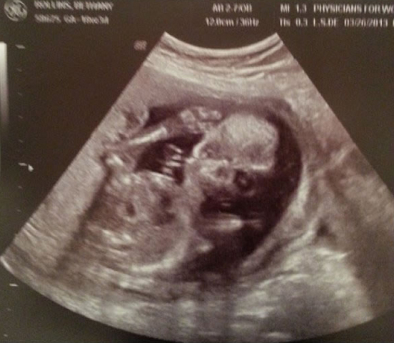 Scary Ultrasound